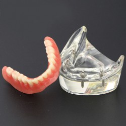 Modèle 6002 02 d’Overdenture Inférieure d’Étude de Démo de Dents Inférieures avec 4 Implants