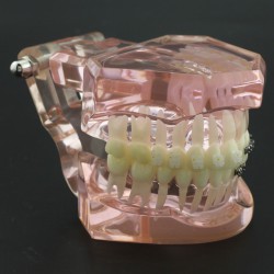 Modèle Orthodontie Contraste des brackets M3009