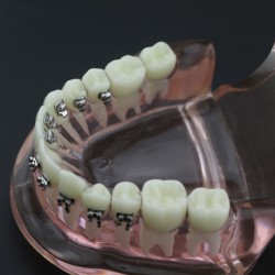 Modèle Orthodontie Contraste des brackets M3009