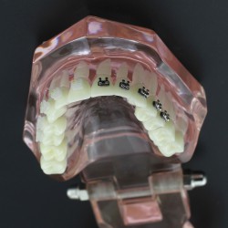 Modèle Orthodontie Contraste des brackets M3009