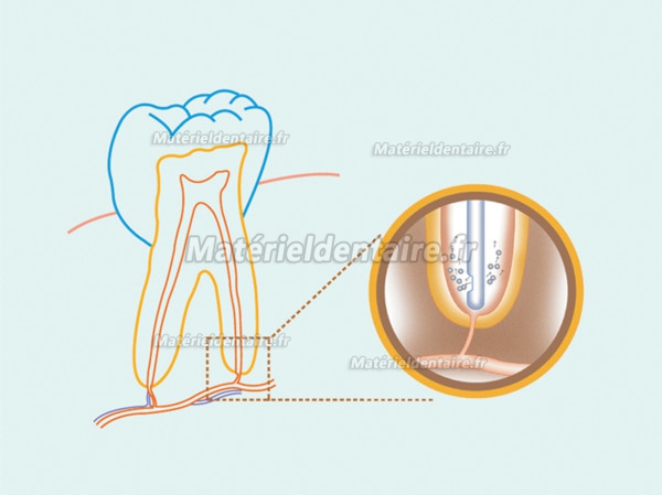 Canules d'irrigation endocanalaire 30G