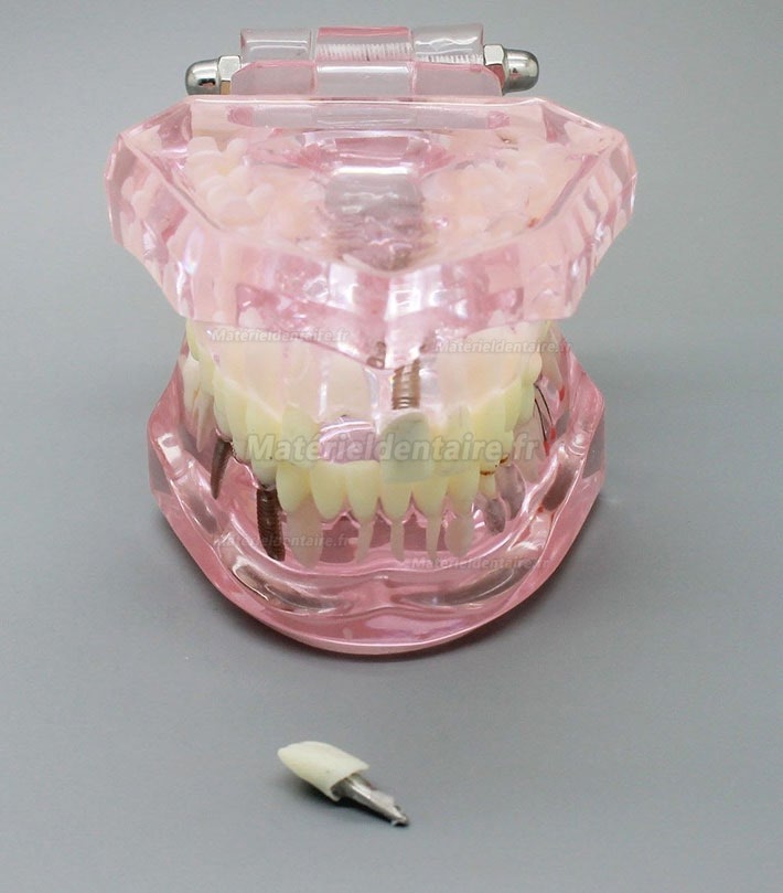 Modèle de dents de démonstration avec analyse d'étude sur implants dentaires avec restauration 2001 rose