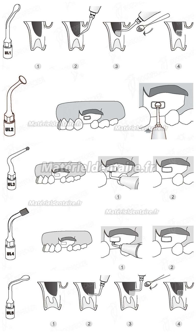 WOODPECKER® INSERTS A PIEZO CHIRURGIE SINUS LIFT KIT