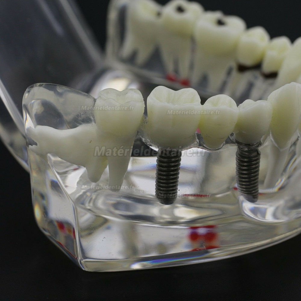 Modèle d'implant démonstration dentaire pour les maladies des dents de Caries Parodonte Rose Transparent