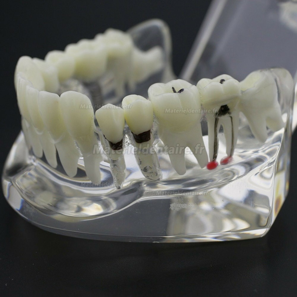 Modèle d'implant démonstration dentaire pour les maladies des dents de Caries Parodonte Rose Transparent