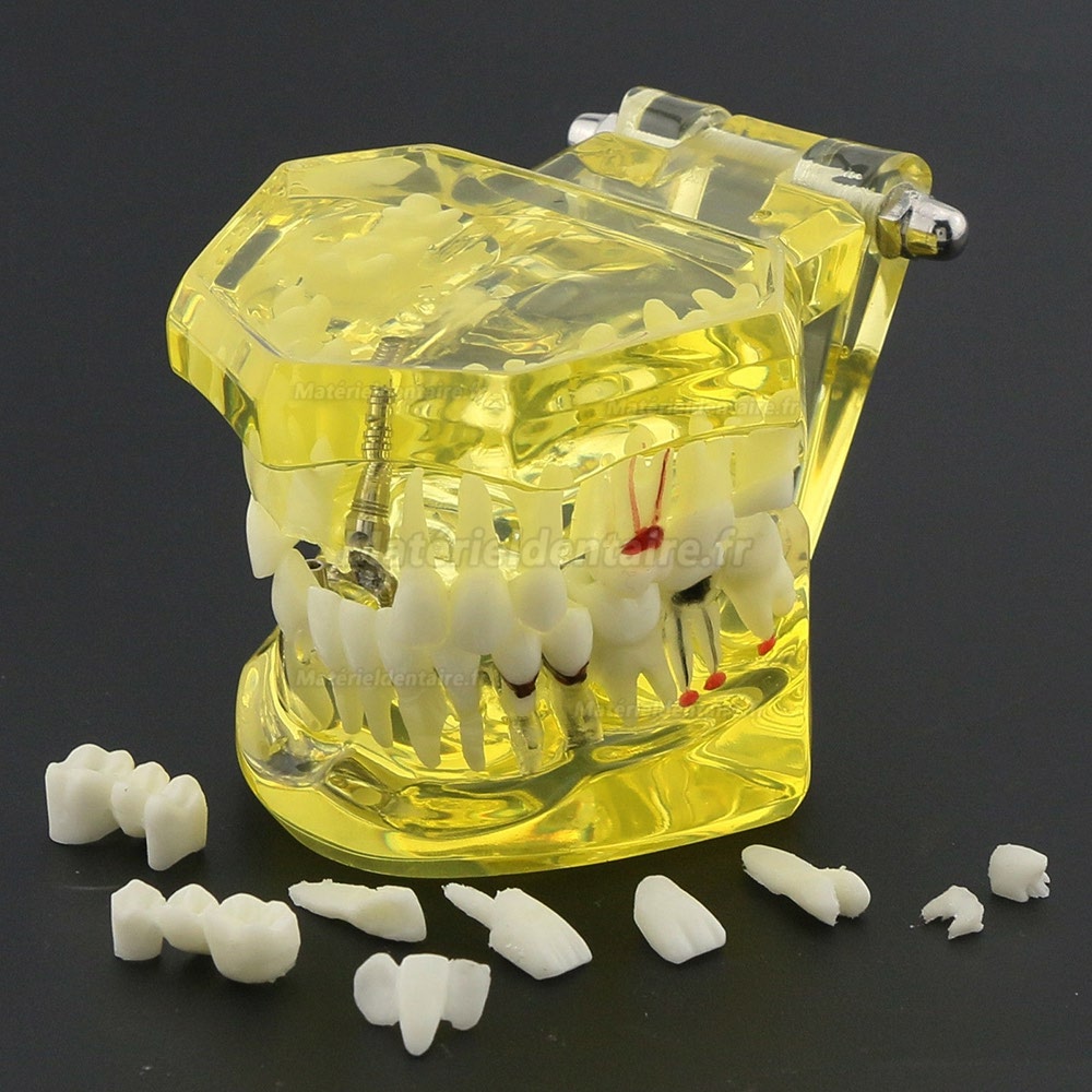 Modèle de dents dentaires Etude Teach Etude d'implantation orale Restauration et pathologie 2001 Jaune