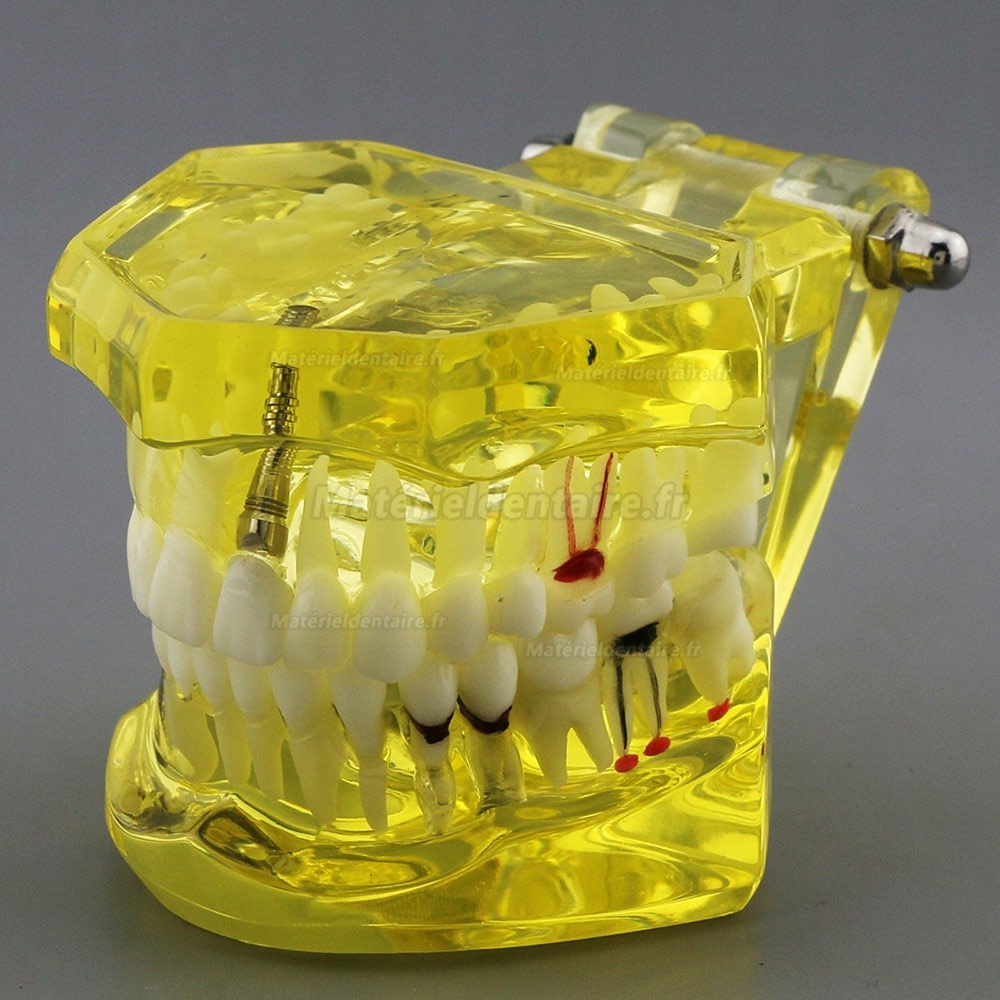 Modèle de dents dentaires Etude Teach Etude d'implantation orale Restauration et pathologie 2001 Jaune