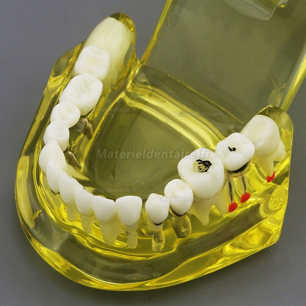 Modèle de dents dentaires Etude Teach Etude d'implantation orale Restauration et pathologie 2001 Jaune