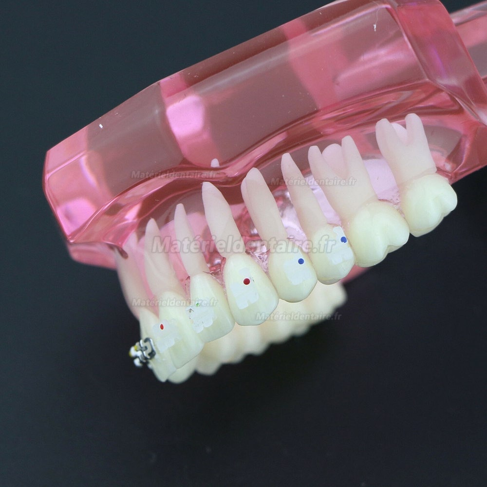 Modèle de Dents Dentaire Orthodontique Bracket métal et céramique étude 3003