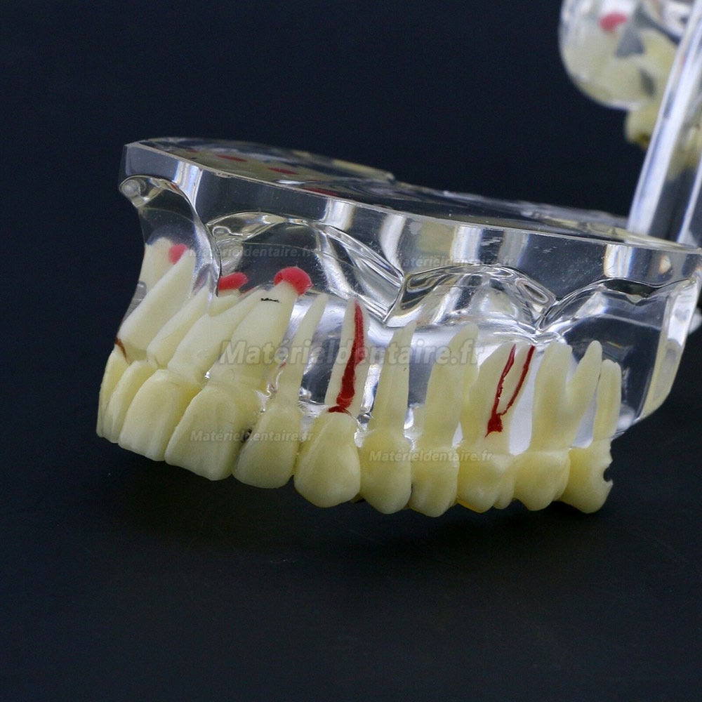 Modèle de dents #4001 pour l’étude et enseignement générale de pathologie Typodont adulte