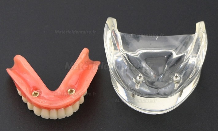 Prothèse Modèle Dentaire Couvert-dentier Inférieur avec 2 Implantations d’Étude de Démo Modèle 6002 01