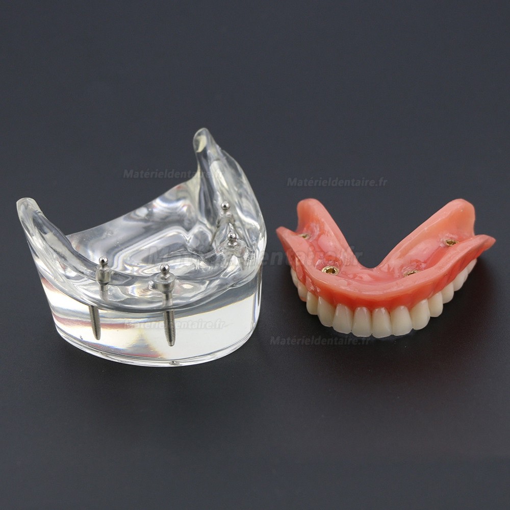 Modèle 6002 02 d’Overdenture Inférieure d’Étude de Démo de Dents Inférieures avec 4 Implants