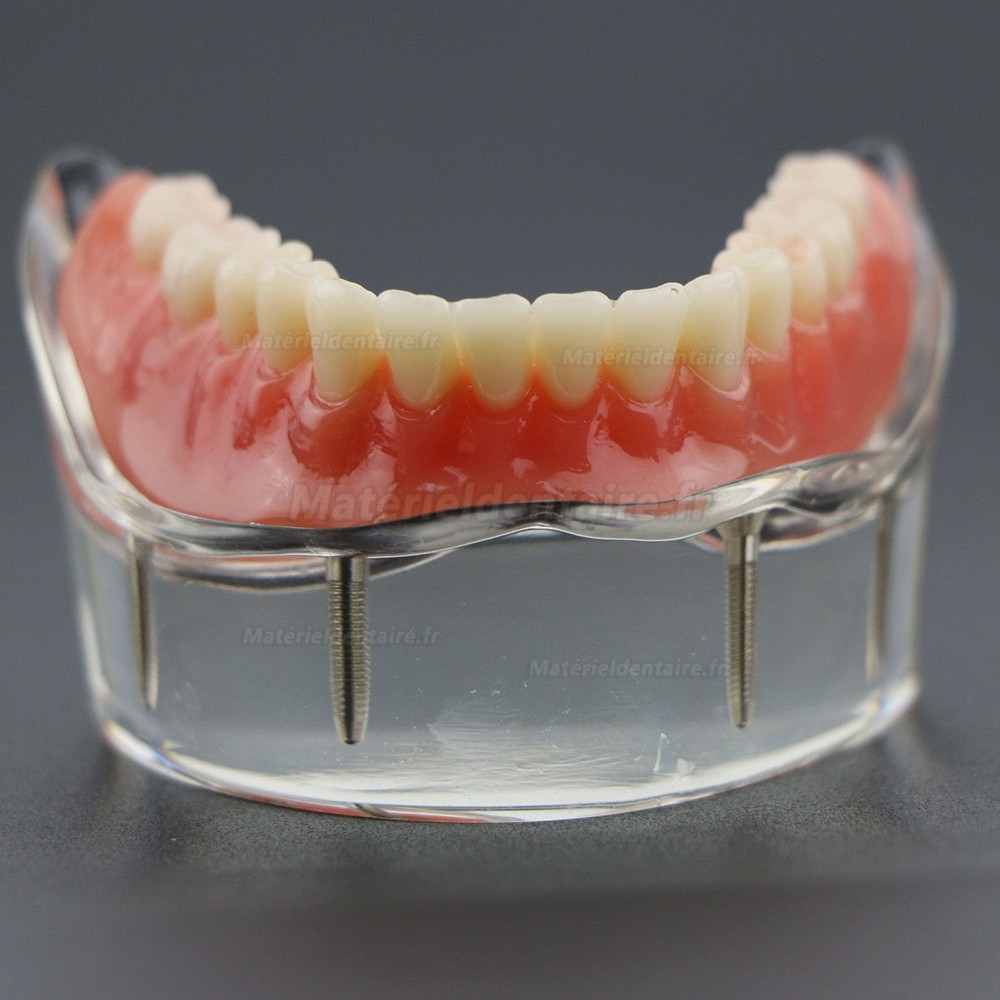 Modèle 6002 02 d’Overdenture Inférieure d’Étude de Démo de Dents Inférieures avec 4 Implants