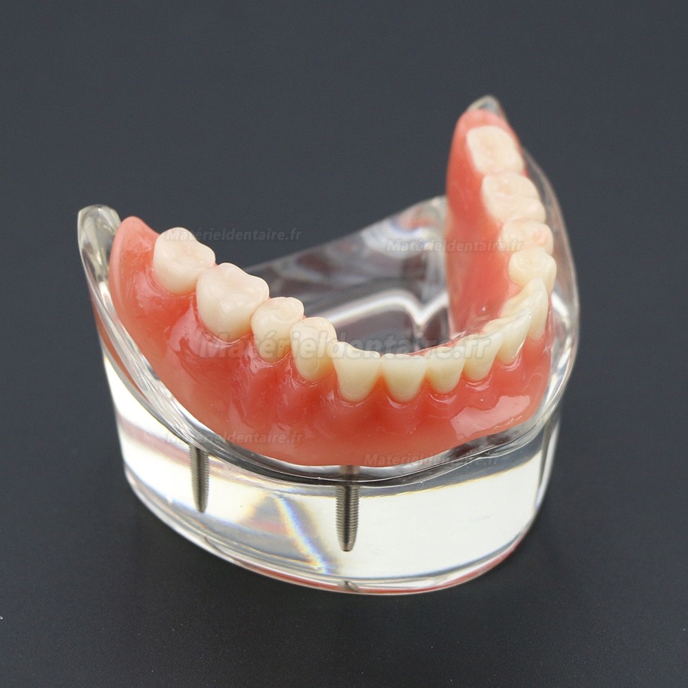 Modèle 6002 02 d’Overdenture Inférieure d’Étude de Démo de Dents Inférieures avec 4 Implants