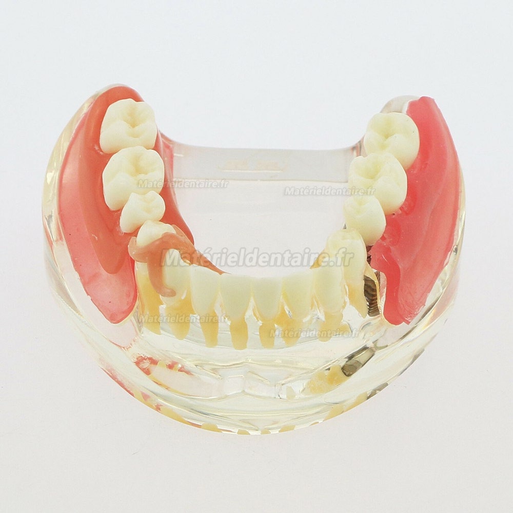 Modèle de démonstration de pont amovible d'implant de restauration de modèle de dents inférieures dentaires 6006