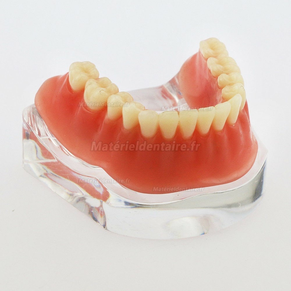 Dentaire inférieur Modèle de dents Overdenture Précision 4 implants Manifestation Bar d'Argent