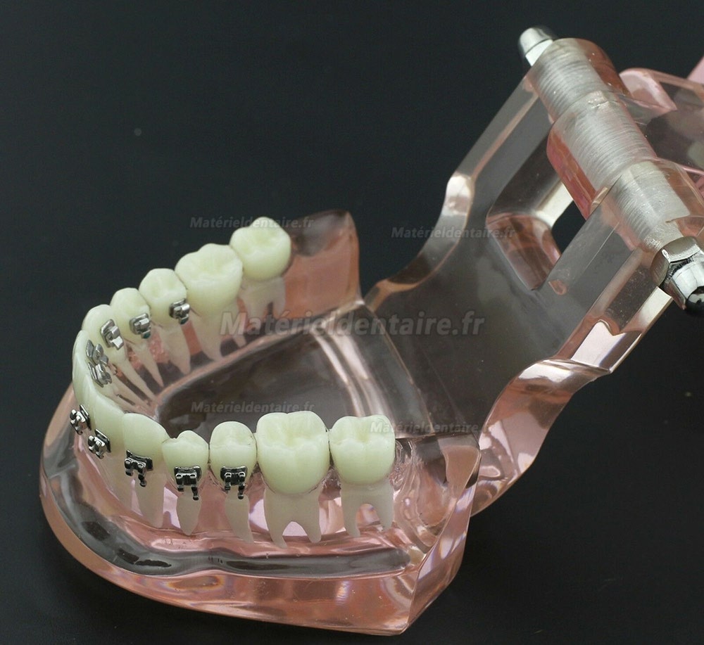 Modèle Orthodontie Contraste des brackets M3009