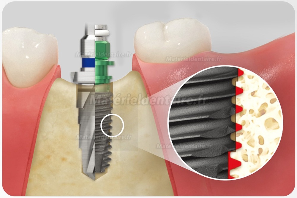 Kit chirurgical cône Osstem Hiossen avec clé dynamométrique (à utiliser pour TSⅢ/Ⅳ SSⅢ USⅢ/Ⅳ)