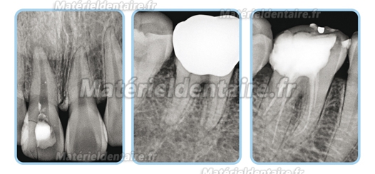 VISIODENT® Capteur plan intra-oral RSV4 pour radiographie dentaire