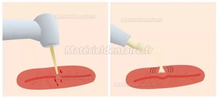 Refine MaxSurgery Appareil piézochirurgie dentaire /appareil chirurgie ultrasonique