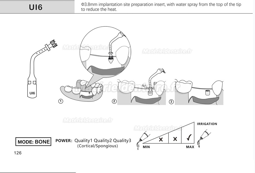 1 Pièces Inserts pour sinus lift latéral Ul1 UI2 UI3 UI4 UI5 compatible avec Mectron Woodpecker Silfradent Dmetec