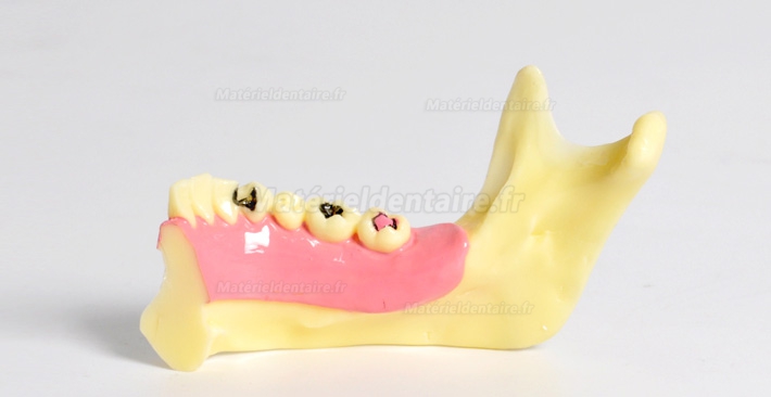 Modèle anatomique dentaire de décomposition du tissu osseux frontal inférieur