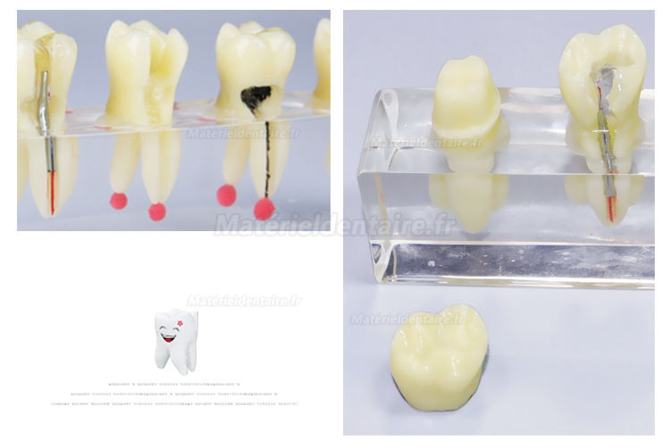 Modèle de pathologie canalaire