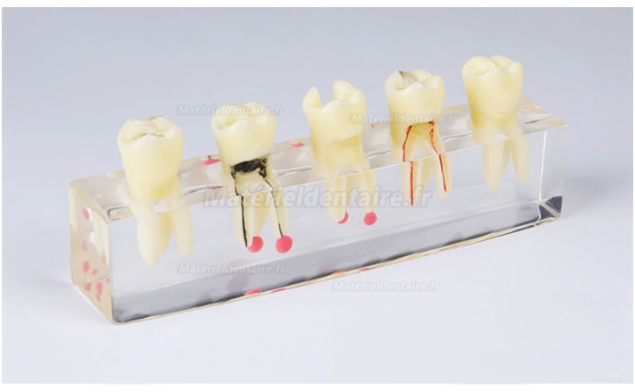 Modèle de pathologie canalaire